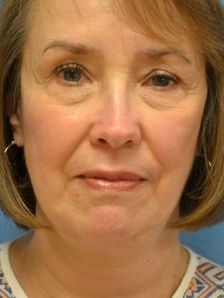 Face & Neck Lifts: FL1431 - Ann Arbor, MI - After