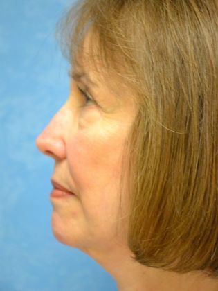 Face & Neck Lifts: FL1431 - Ann Arbor, MI - After