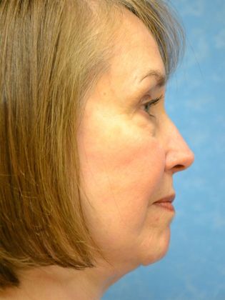 Face & Neck Lifts FL1431 - Ann Arbor, MI - After