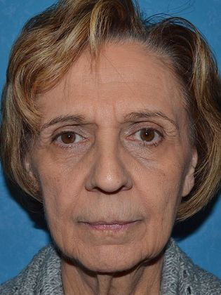 Face & Neck Lifts: FL1234 - Elida, OH - Before