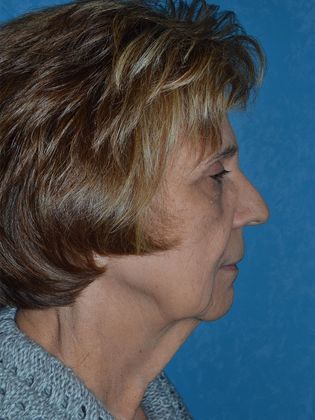 Face & Neck Lifts FL1234 - Elida, OH - Before