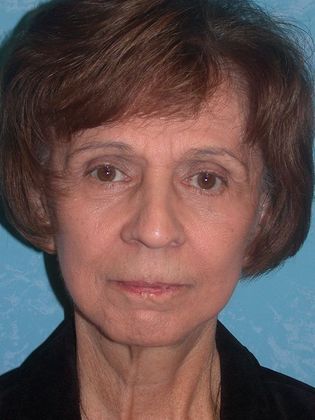 Face & Neck Lifts: FL1234 - Elida, OH - After