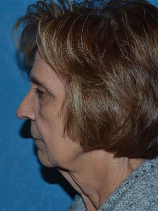 Face & Neck Lifts: FL1234 - Elida, OH - Before