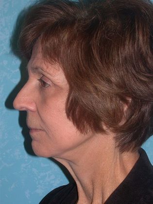 Face & Neck Lifts: FL1234 - Elida, OH - After