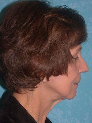 Face & Neck Lifts FL1234 - Elida, OH - After