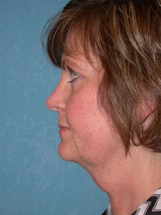 Face & Neck Lifts: FL1336 - Defiance, OH - Before