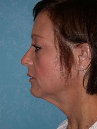 Face & Neck Lifts: FL1438 - Defiance, OH - Before