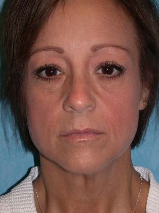 Face & Neck Lifts: FL1438 - Defiance, OH - Before