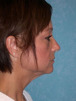 Face & Neck Lifts: FL1438 - Defiance, OH - Before