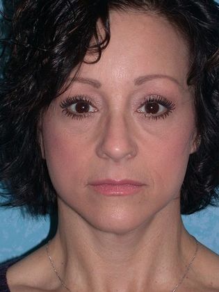 Face & Neck Lifts: FL1438 - Defiance, OH - After