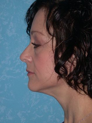 Face & Neck Lifts: FL1438 - Defiance, OH - After