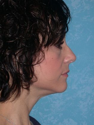 Face & Neck Lifts: FL1438 - Defiance, OH - After