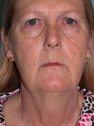 Face & Neck Lifts FL1441- Swanton, OH - Before