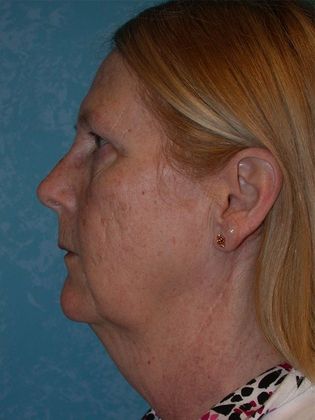Face & Neck Lifts: FL1441- Swanton, OH - Before
