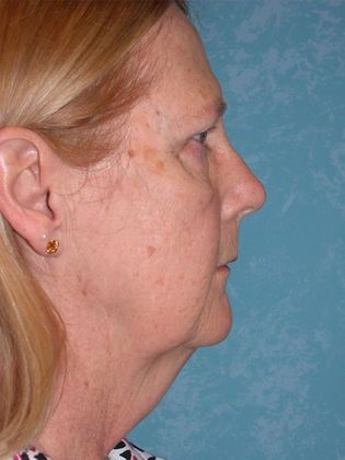Face & Neck Lifts: FL1441- Swanton, OH - Before