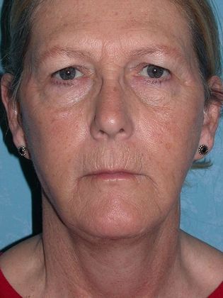 Face & Neck Lifts FL1441- Swanton, OH - After