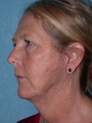 Face & Neck Lifts: FL1441- Swanton, OH - After