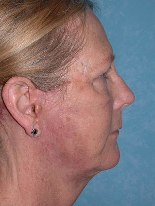 Face & Neck Lifts: FL1441- Swanton, OH - After