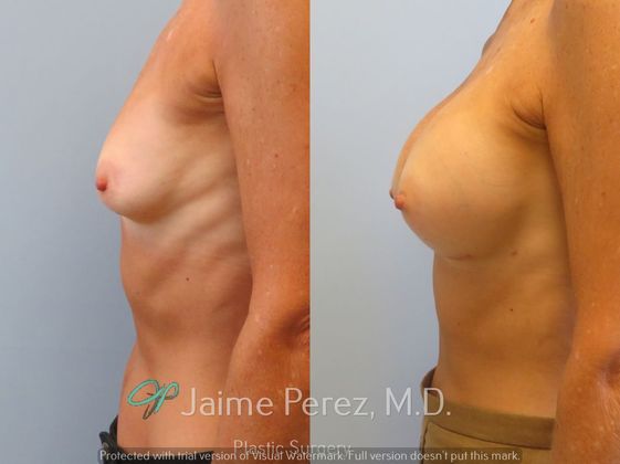 Breast Augmentation: 65-Year-Old Female: Breast Augmentation with Silicone Implants - Before & After