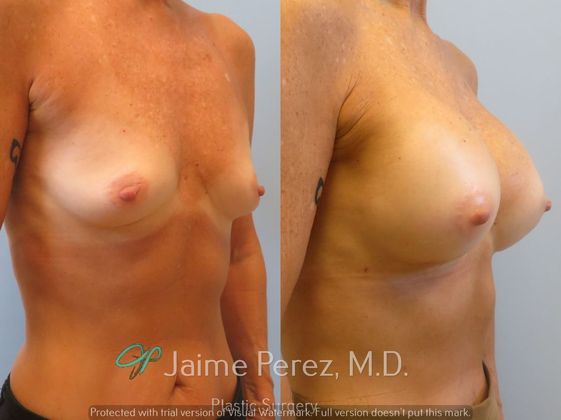 Breast Augmentation: 65-Year-Old Female: Breast Augmentation with Silicone Implants - Before & After