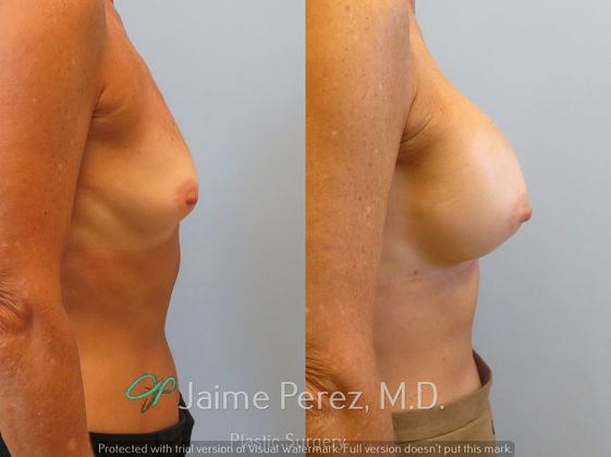 Breast Augmentation: 65-Year-Old Female: Breast Augmentation with Silicone Implants - Before & After