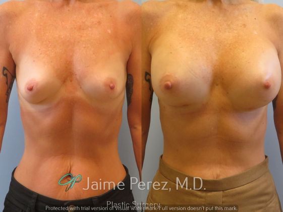 Breast Augmentation: 65-Year-Old Female: Breast Augmentation with Silicone Implants - Before & After