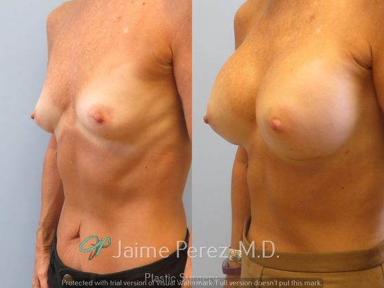 Breast Augmentation: 65-Year-Old Female: Breast Augmentation with Silicone Implants - Before & After