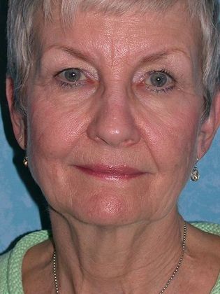 Face & Neck Lifts: FL1552 - Toledo Oh - Before