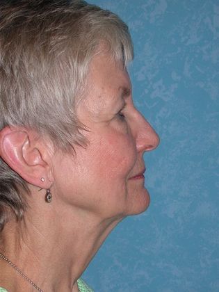 Face & Neck Lifts FL1552 - Toledo Oh - Before