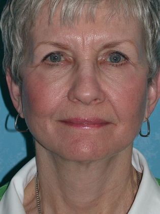 Face & Neck Lifts: FL1552 - Toledo Oh - After