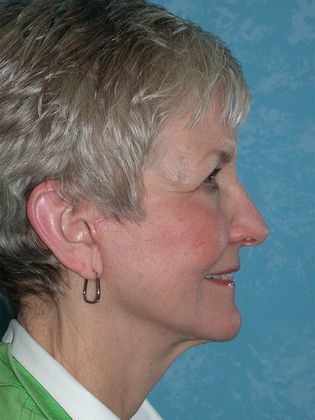 Face & Neck Lifts FL1552 - Toledo Oh - After