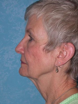 Face & Neck Lifts: FL1552 - Toledo Oh - Before