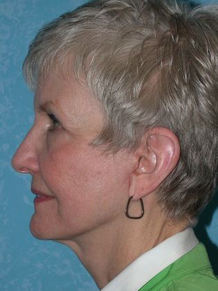 Face & Neck Lifts: FL1552 - Toledo Oh - After