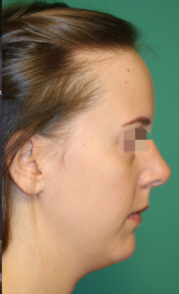 Hairline Lowering Surgery: Case 8 - Before