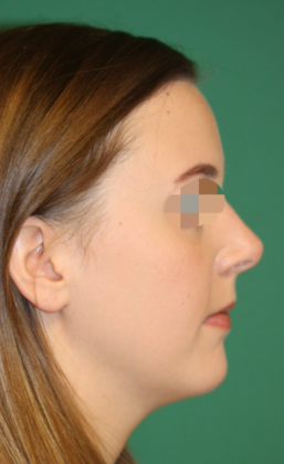 Hairline Lowering Surgery: Case 8 - After