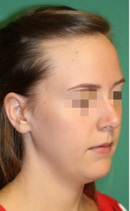 Hairline Lowering Surgery: Case 8 - Before