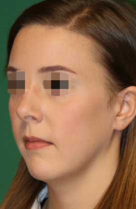 Hairline Lowering Surgery: Case 8 - After