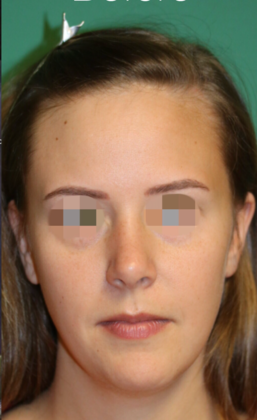 Hairline Lowering Surgery: Case 8 - After