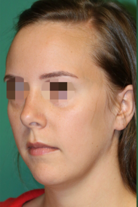 Hairline Lowering Surgery: Case 8 - Before