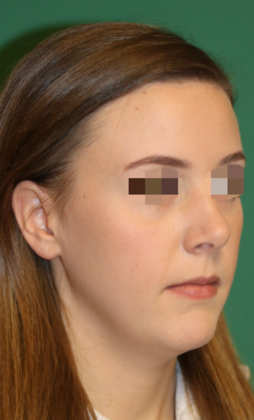 Hairline Lowering Surgery: Case 8 - After
