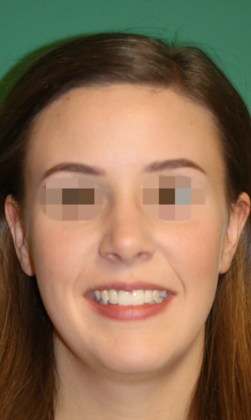 Hairline Lowering Surgery: Case 8 - Before