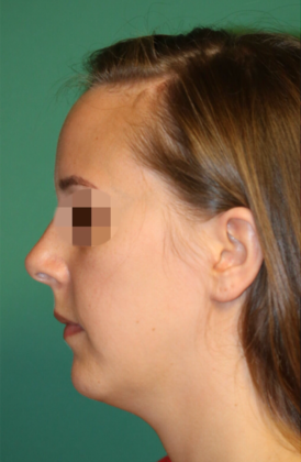 Hairline Lowering Surgery: Case 8 - Before