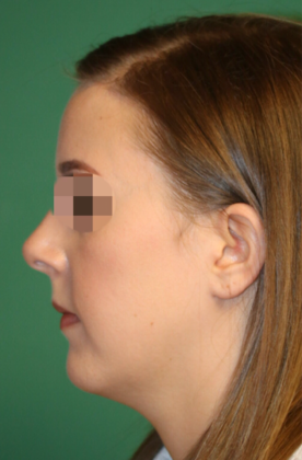 Hairline Lowering Surgery: Case 8 - After
