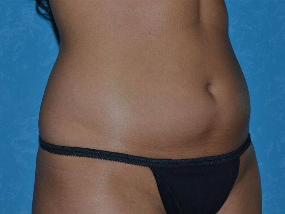 Coolsculpt: CS1605 - Bowling Green, OH - Before