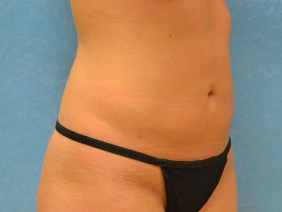 Coolsculpt: CS1605 - Bowling Green, OH - After