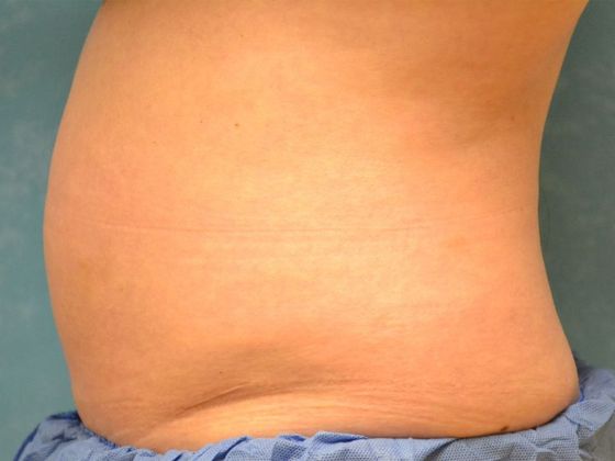 Coolsculpt: CS1610 - Sylvania, OH - Before