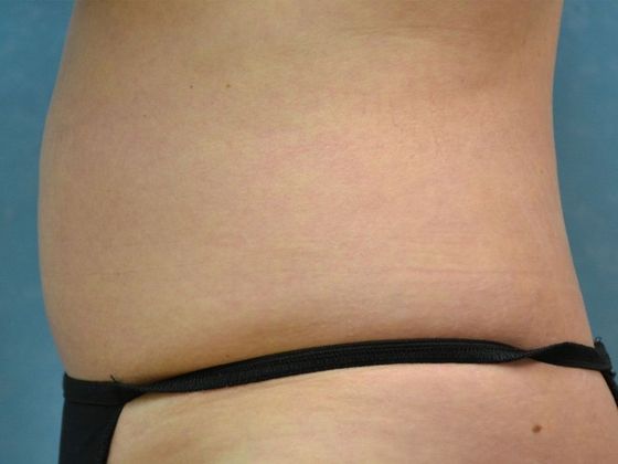 Coolsculpt: CS1610 - Sylvania, OH - After