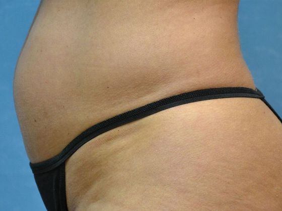 Coolsculpt: CS1714 - Sylvania, OH - Before