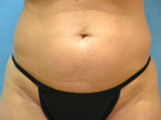 Coolsculpt: CS1714 - Sylvania, OH - Before