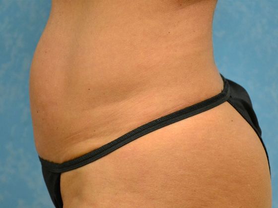 Coolsculpt: CS1714 - Sylvania, OH - After